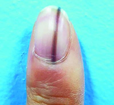 손톱의 까만선은 악성 흑색종의 징후일 수 있다. 국립암센터 제공