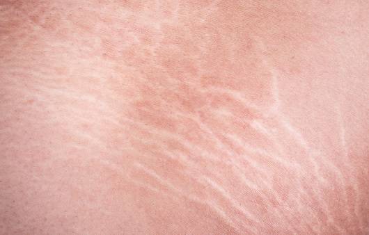 튼살이 생기는 이유