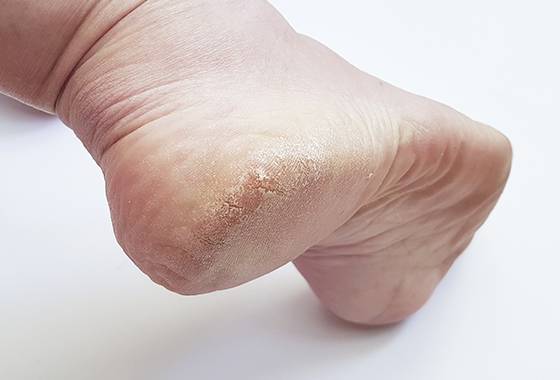 두꺼워진 발꿈치 각질 모습./사진=게티이미지뱅크
