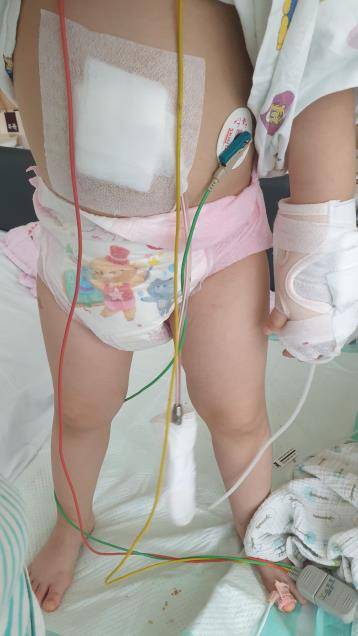 안산 A 유치원에서 발생한 집단식중독으로 용혈성요독증후군 진단을 받은 B(4) 양이 입원치료 중인 모습. [B 양 엄마 C 씨 제공. 재판매 및 DB 금지]