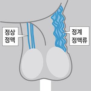 고환의 혈관이 튀어나오거나 열감을 느낀다면 정계정맥류를 의심할 수 있다./사진=조선일보 DB