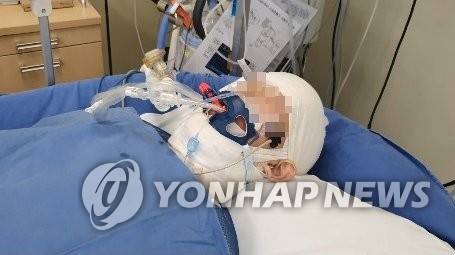 지하철역 감전사고로 전신화상 입은 중학생 (양주=연합뉴스) 지난 4일 오후 경기 양주시 지하철 1호선 덕정역에서 선로 위에 정차 중이던 화물열차 위에서 고압선에 감전돼 중학생이 전신화상을 입었다. 사진은 서울의 한 화상전문 치료병원에서 다친 학생이 치료 중인 모습. 2020.9.11 [제보자 제공. 재판매 및 DB금지] suki@yna.co.kr