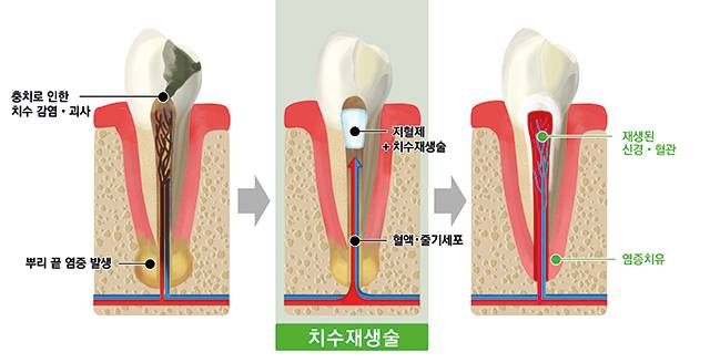 '긁어내는' 신경치료 대신, 치수재생으로 자연치아 보존한다?