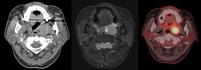 왼쪽부터 편도암이 관찰된 최 씨의 CT, MRI, PET-CT 영상