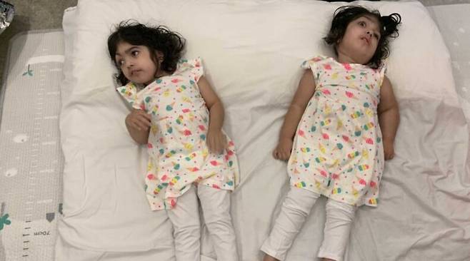 분리 수술에 성공한 샴쌍둥이 자매 사파 비비, 마르와 비비. /BBC