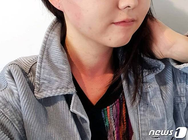 그림을 그리고 싶어 혼자 양평 여행을 떠난 지난 4월, 모자를 썼음에도 햇빛을 받으며 걸으니 얼굴과 목 부위가 벌겋게 부어올랐다. (이고은씨 제공) © 뉴스1