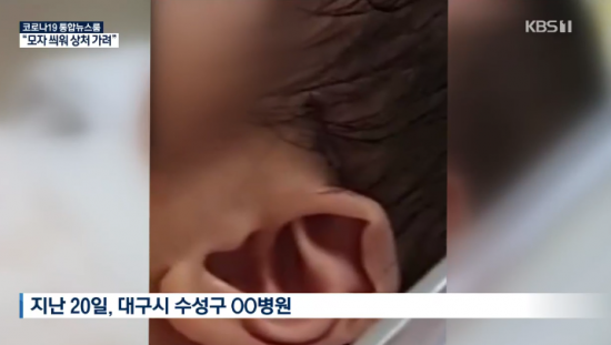 23일 KBS에 따르면, 대구의 한 병원에서 지난 16일 제왕절개 수술 도중 수술용 칼로 신생아 머리에 5cm 정도의 상처를 내고 꿰맨 뒤 곧바로 아기의 부모에게 알리지 않았다. 사진=KBS뉴스 방송화면 캡처.