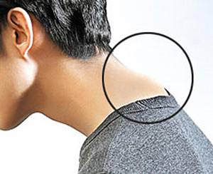 버섯증후군은 뒷목 아래 경추 7번 뼈 일부가 돌출된 상태다./사진=헬스조선 DB