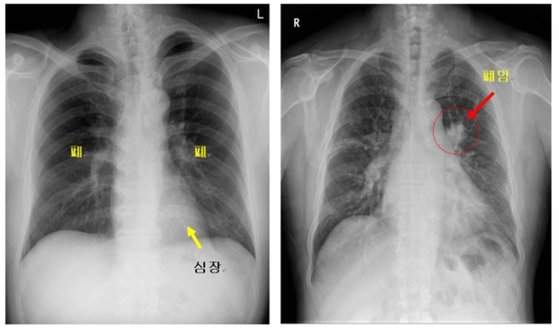 정상인 폐 모습(왼쪽)과 폐암 환자의 X레이. 대한폐암학회
