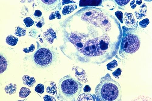 인간의 림프종 세포 = 림프종에 화학 치료제를 쓰면 암세포의 염색체가 비정상으로 늘어나고 세포 자체도 커지는 경우가 많다.  [미 국립 암연구소 제공 / 재판매 및 DB 금지]