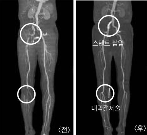 말초동맥질환 시술 전후 혈관 CT/헬스조선 DB