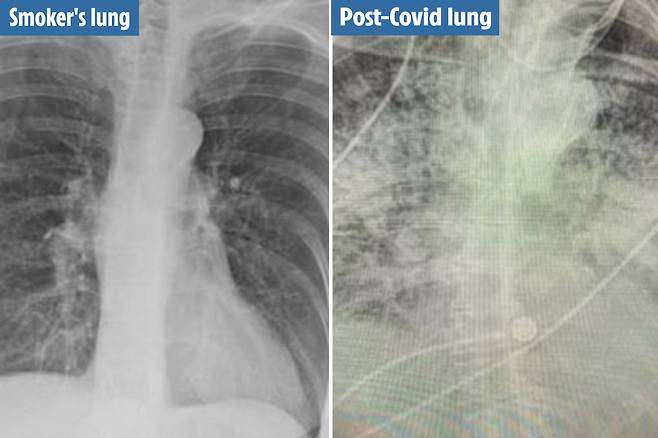 “어떤 흡연자보다 심각”…美 의사, 코로나19 환자 폐 사진 공개(사진=브리트니 뱅크헤드켄들 박사 제공)