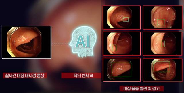 대장내시경 인공지능 소프트웨어(AI SW)는 용종이 보이면 모니터에 실시간으로 표시해줘 의사가 놓칠 위험을 줄여준다. /자료=가천대 길병원
