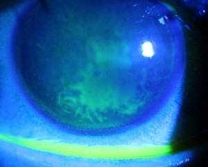 눈에 화상을 입는 각막화상은 일상 속 부주의로도 발생할 수 있어 주의가 필요하다./사진=김안과병원 제공