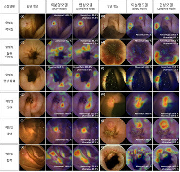 딥러닝 알고리즘이 소장 병변을 탐지해 시각화한 영상. 인공지능이 병변으로 판단한 부분이 Grad-CAM에 의해 붉은색으로 표시됨.