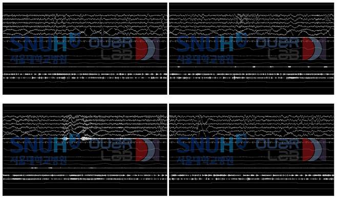 서울대병원이 구축한 수면다원검사 결과 데이터 샘플 이미지 (사진=서울대병원)