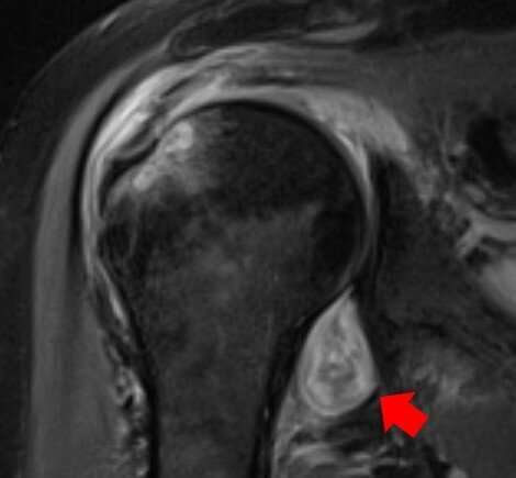 어깨 부위에 세포 염증이 발생한 코로나19 환자의 MRI. 노스웨스턴대학 제공