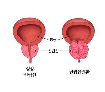 전립선 비대증 [출처: 서울아산병원]