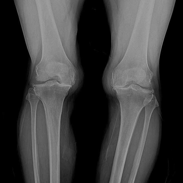 퇴행성관절염이 많이 진행된 환자의 다리 엑스레이 사진./사진=연세사랑병원 제공