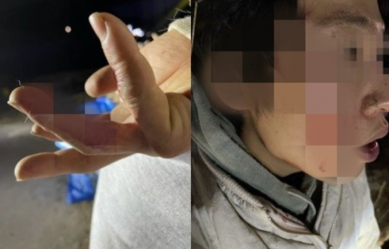 한 시민이 경기도 가평군에서 로트와일러에 공격당했다. 얼굴과 손가락 등을 물려 10바늘 이상 꿰맸다. 사진=온라인 커뮤니티 캡처.