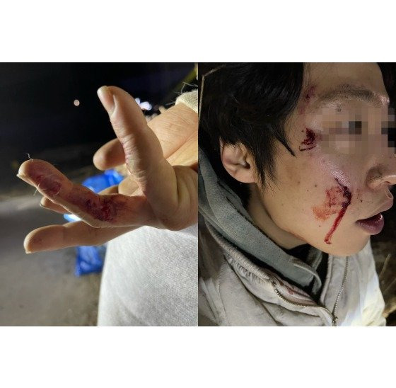 경기도 가평군에서 발생한 개물림사고로 반려견 보호자 A씨는 얼굴과 손가락 등을 물려 10바늘 이상 꿰맸다. 해당 맹견은 목줄이 풀린 상태로 반려견과 A씨를 덮쳤다. A씨 제공