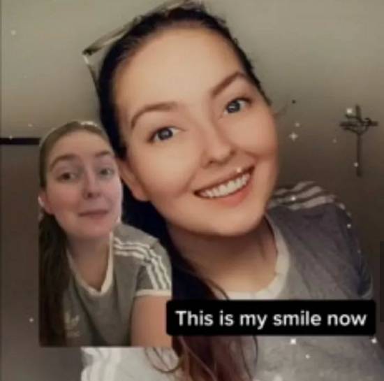 양치를 제대로 하지 않아 앞니가 다 썩어버린 빅토리아 아이린 노바코프스키. 의치를 심었다. SNS 캡처