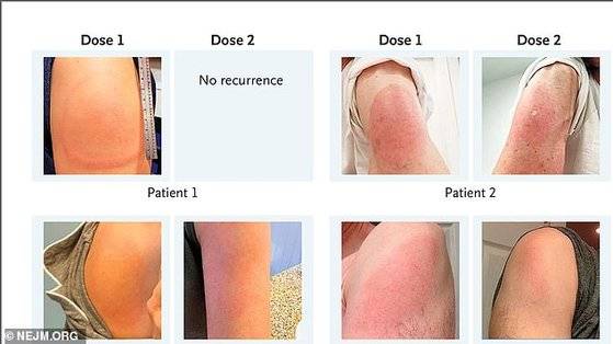 모더나 백신을 맞고 난 뒤 일부 접종자에게서 '붉은 팔'현상이 나타났다.[뉴잉글랜드 저널 오브 메디신, 트위터]