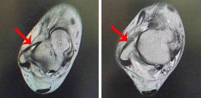 　◇정상 발목인대(왼쪽)와 손상된 발목인대