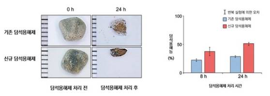 한 해 20만 명 넘게 걸리는 담석증, 수술 안 해도 된다고요?