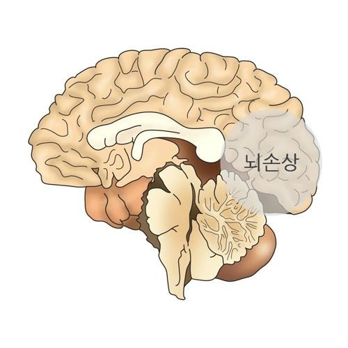 외상성 뇌 손상(TBI) [출처: 서울아산병원]