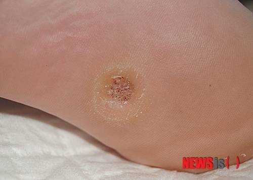 【서울=뉴시스】오제일 기자 = 사마귀는 바이러스에 감염돼 피부에 딱딱한 군살이 생기는 피부 질환이다. kafka@newsis.com