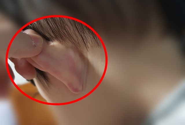 제주 도내 한 어린이집에서 학대 피해를 입은 아이의 귀 모습. (사진=피해부모 제공) *재판매 및 DB 금지