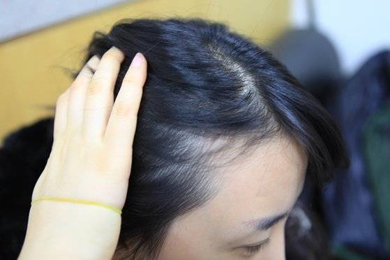 탈모 증상을 완화하는 제품은 식품과 의약품, 화장품으로 구분된다. 사진은 탈모 의약품 처방을 받기 위해 병원을 방문한 탈모 환자. [고대안산병원]