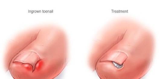 내성 발톱 보존적 치료 / 선상규 원장 제공