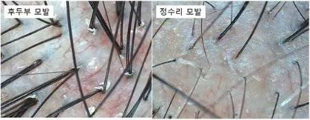 여성형 탈모 3단계 환자의 후두부. 정수리 모발 두께와 차이가 난다. [사진 전지훈]