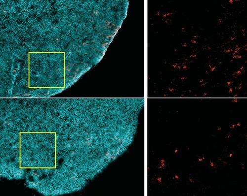 비만과 T세포 암세포만 골라 죽이는 CD8+ T세포(적색)는, 비만한 생쥐(하단)보다 비만하지 않은 생쥐(상단)의 종양(청록색)에 더 많다.   [하버드의대 Ringel 등 제공 / 재판매 및 DB 금지]