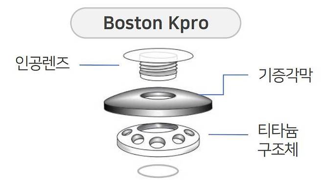 보스턴 케이프로 인공각막 구조, 출처: 티이바이오스