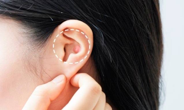 표피낭종을 잘못 짜 주머니가 피부 안에서 파괴되면 피부 내부 손상이 심해질 수 있다./사진=헬스조선DB