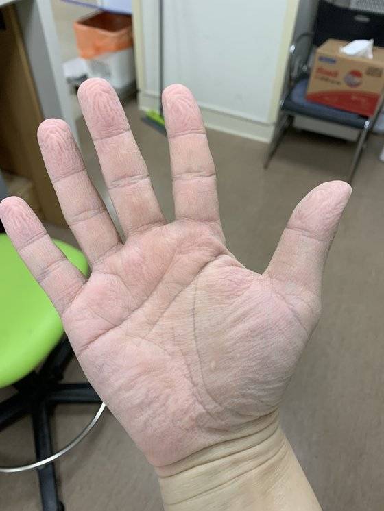 강원도 원주세브란스기독병원 외상 응급실에서 일하는 김한용(36) 간호사. 땀에 절은 방호복을 벗자 손이 퉁퉁 불어있는 모습이다. [김한용씨 제공]