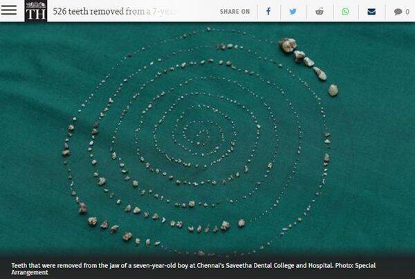 인도 7세 소년 턱에서 발견된 526개의 치아.