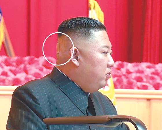 bandage-on-back-of-kim-jong-un-s-head-draws-unsolicited-theories