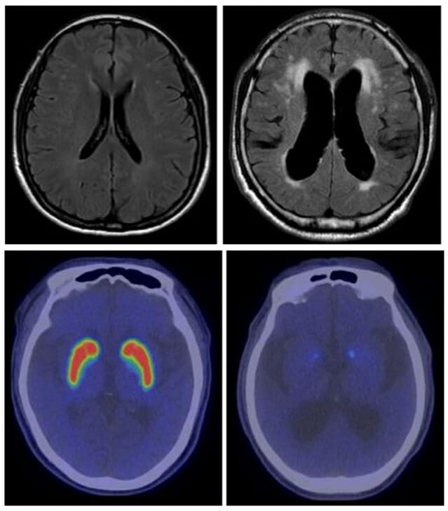 (위 사진) 왼쪽 정상 뇌에 비해 오른쪽 정상압 수두증 환자에서는 과다 축적된 뇌척수액으로 인해 뇌실이 확장되어 있는 것을 확인할 수 있다. (아래 사진) 아래 왼쪽 정상 뇌에 비해 오른쪽 파킨슨병 환자의 뇌에서는 기저핵 부위에 반응이 약하게 나타난다. (사진=분당서울대병원)