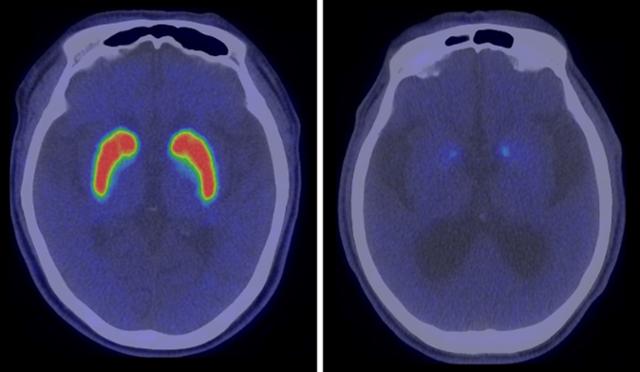 정상 뇌(왼쪽)와 파킨슨병 환자의 뇌(오른쪽) PET 비교 사진. 분당서울대병원 제공