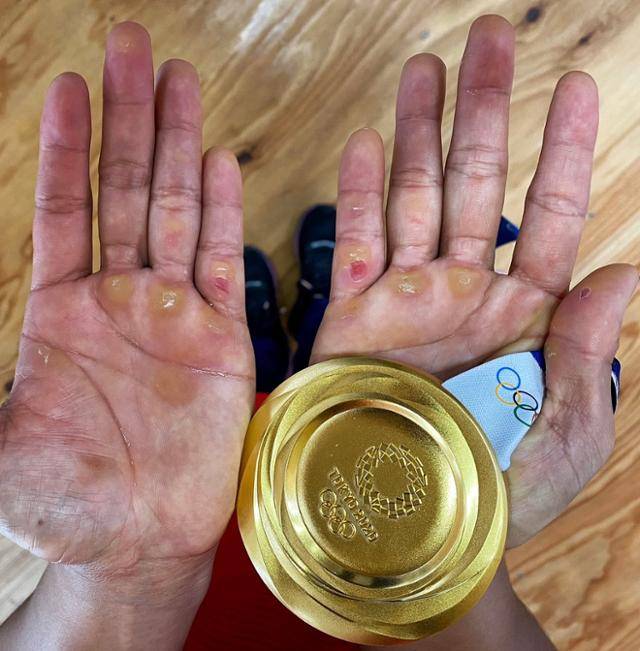 필리핀 역사상 첫 올림픽 금메달을 딴 하이딜린 디아즈의 굳은살 박힌 손. 디아즈 트위터