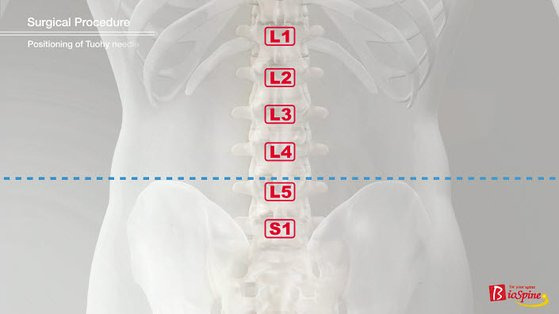 점선이 골반뼈의 상단 테두리에 해당하는 엉덩뼈능선의 높이를 표시한다. 환자마다 개인차가 있어 L5~S1 마디의 추간공접근법 진행 시 가장 중요한 변수가 된다. [사진 서울 광혜병원]