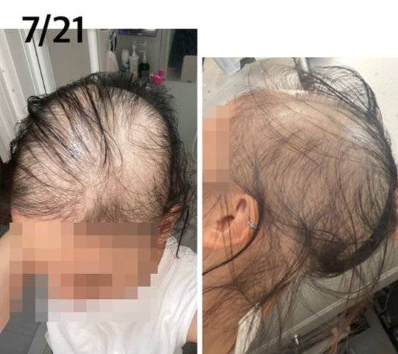 모더나 백신을 맞은 뒤 탈모가 시작됐다고 주장하는 일본 여성 [출처: 블로그]