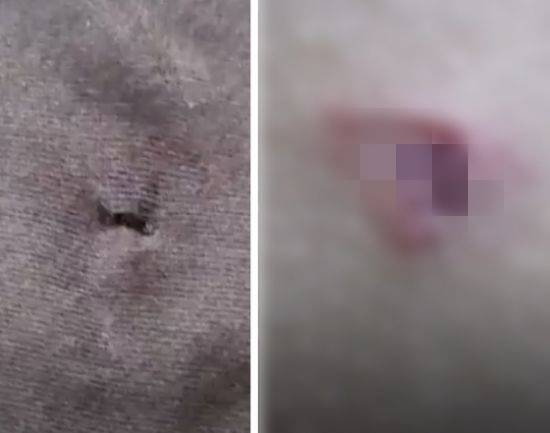 경북 예천 한 중학교 양궁부 3학년 주장이 쏜 연습용 화살에 맞은 후배 선수의 옷(왼쪽)과 등 쪽에 난 상처. KBS
