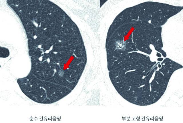 순수 간유리 음영(붉은 화살표)과 단단한 성분이 부분적으로 섞인 간유리 음영의 CT 영상. 강남세브란스병원 제공