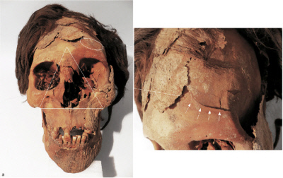 칠레 아타카마 사막에서 발굴된 신석기 시대 인류의 유골. 안면의 위턱과 코 안쪽 뼈가 강한 충격을 받아 부서졌다(왼쪽 사진). 이마에는 둔기로 가격당한 흔적이 보인다(오른쪽 사진).  칠레 타라파카대·미국 툴레인대 제공