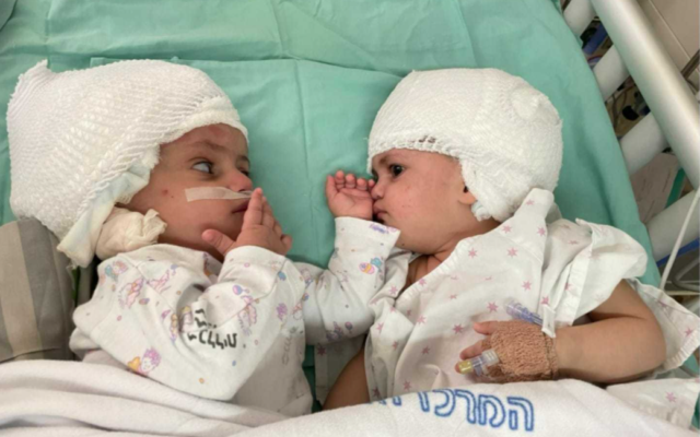 이스라엘에서 12시간 넘는 대수술 끝에 분리에 성공한 샴 쌍둥이. 이스라엘 오브 타임즈 캡처